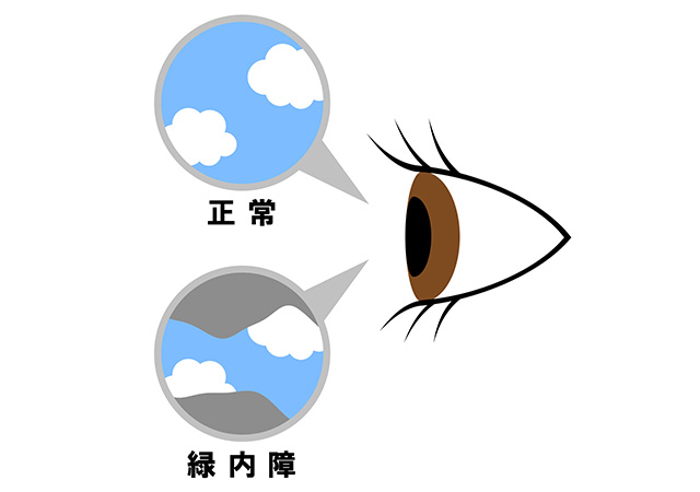 緑内障症状イメージ
